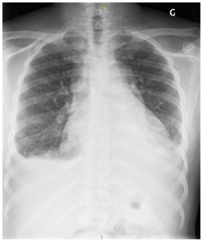 Figure 2 Antero-posterior chest X-ray of our patient 5 days after presentation.
