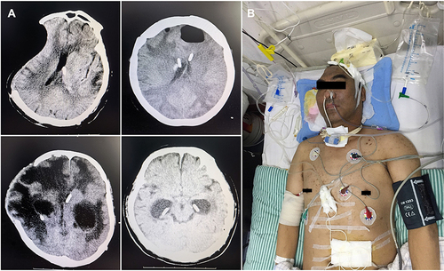 Figure 1 Multiloculated hydrocephalus and skin pigmentation in carbapenem-resistant MDR/XDR gram-negative central nervous system infections. (A) CT indicated multiloculated hydrocephalus in 23 carbapenem-resistant MDR/XDR gram-negative central nervous system infections. (B) One patient developed hyperpigmentation after receiving 50 mg q12h intravenous Polymyxin B for 31 days.