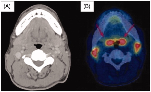 Figure 3. Scans from contrast enhanced computed tomography (CECT) and 18F-fluorodeoxyglucose-positron emission tomography (18F-FDG PET) imaging studies. (A) A CECT scan showing bilateral swelling of lymph nodes and normal tonsils that are not enhanced. (B) An 18F-FDG PET scan shows accumulation of 18F-FDG within the physiological range (maximum standardized uptake value [SUVmax], 5.1 and 5.1 in right and left sides, respectively) in bilateral tonsils, whereas 18F-FDG accumulation is observed at significant levels in bilateral submandibular lymph nodes (SUVmax, 4.7 and 4.3 in right and left sides, respectively).