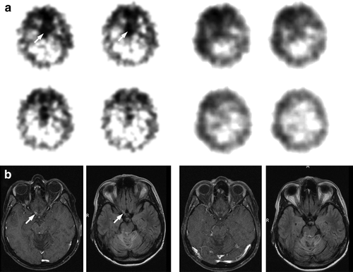Figure 1.  111In-octreotide-szintigraphy before treatment (4 panels left) and during treatment (4 panels right) with Sandostatin LAR™ (after 4 cycles). Arrows show positive receptor status. B. MRI (T1 plus Gadolinium and FLAIR) before treatment (2 panels left) and during treatment (2 panels right) after 4 cycles with Sandostatin LAR™. Arrows show contrast enhancement (T1) and hyperintensity (FLAIR).