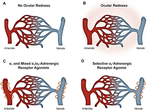 Figure 2 Current understanding of the difference in mechanism of action of α-adrenergic receptor agonists for relief of ocular redness. (A) Blood vessels in the conjunctiva under normal conditions (without ocular redness). (B) Ocular redness results from the dilation of arterioles and venules. (C) α1-adrenergic receptor agonists primarily constrict arterioles to reduce redness, whereas mixed α1/α2-adrenergic receptor agonists can impact both arterioles and venules. (D) Selective α2-adrenergic receptor agonists primarily constrict the venules to reduce redness. Of relevance to potential side effects, constriction of arterioles through use of α1- or mixed α1/α2-adrenergic receptor agonists can reduce oxygen delivery to the conjunctiva and lead to ischemia, which, in turn, can be associated with rebound redness following discontinuation. Selective α2-adrenergic receptor agonists effect venular constriction thereby preventing ischemia and subsequent rebound redness. Further research is needed on vascular tone in conjunctival tissue to gain a better understanding of the change(s) in caliber of conjunctival arterioles and venules in ocular redness and their differential response to ocular decongestants.