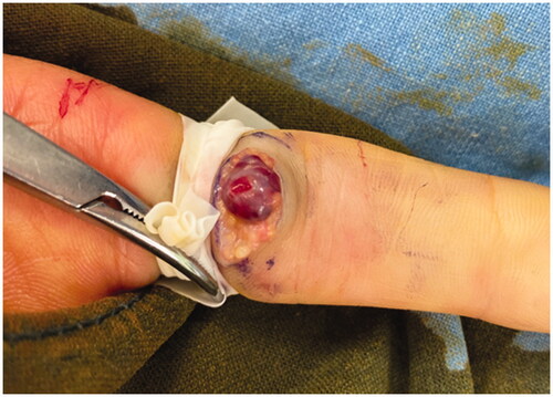 Figure 2. Intraoperative photograph shows a soft, red purple, and well-circumscribed cystic mass looking like a hemangioma at the volar surface of left 2nd proximal phalanx.