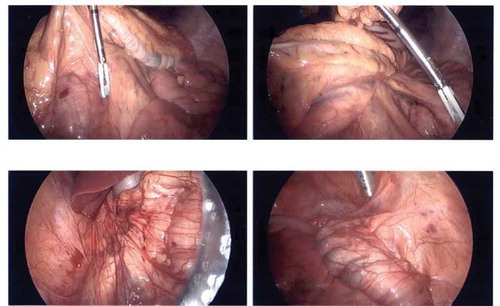 Figure 2. Laparoscopic images of abdomen. Mobile right colon easily reaching the left lower quadrant, and loose right peritoneum