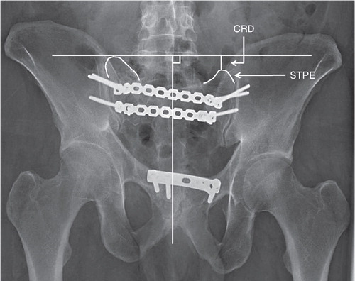 Figure 1. Measurement of cephalad residual displacement (CRD) of the right hemipelvis and sacrum illustrated on a pelvic outlet image. A midline vertical line is drawn along the axis of the central portion of the sacrum. A horizontal line, perpendicular to the vertical line, is drawn on the highest of the 2 measurement points—in this case, the lateral top points of the sacral transverse process elements (STPE). The difference in height between the horizontal line and the lowest of the 2 measurement points is the CRD.