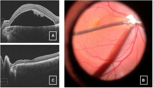 Figure 2 (A) Preoperative horizontal OCT scan through the optic disc and fovea, showing an abundance of subretinal macular fluid, extending towards the ODP as well as subretinal hyperreflective deposits suggesting a long-standing case. (B) Intraoperative fundus picture showing the autologous scleral plugging into the ODP. (C) Postoperative follow-up image showing foveal re-attachment with no evidence of subretinal fluid but with residual local alterations at the Interdigitation and ellipsoid zones.Abbreviations: OCT, optical coherence tomography; ODP, optic disc pit.