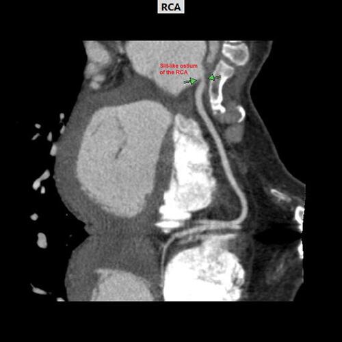 Figure 6 The patient’s cardiac computed tomography angiogram (cCTA) demonstrates the slit-like ostial right coronary artery compression or vasospasm between the green arrows.
