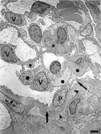 Fig. 7 Transmission electron micrograph (TEM) of glomerular tuft (asterisk) of a cyst. Parietal (P) and visceral (V) podocytes contain variable numbers of microvilli. Poor developed foot processes are observed in parietal podocytes (arrows). The glomerular basement membrane is focally thickened (solidcircles). Parietal basement membrane (arrowheads). Bar = 2,040 nm.