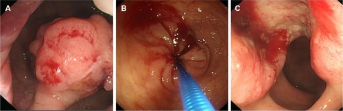Figure 1 Colonoscopic findings of expansive, infiltrative and ulcerative growth patterns of colorectal cancer.Notes: (A) expansive subtype, (B) infiltrative subtype and (C) ulcerative subtype.