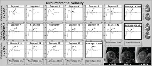 Figure 4 Circumferential velocity graphs for individual left ventricular segments (American Heart Association segmentation model) showing the influence of reflected aortic pressure waves on circumferential motion in early diastole. The graphs represent average values for all volunteers. Positive values correspond to clockwise rotation of the left ventricle as viewed from the apex, while negative values reflect counterclockwise motion. Average velocities for basal, mid, and apical slices are shown in bold outline. The arrows (a) show a brief notch of clockwise rotation in early diastole. At the ventricular apex and mid ventricle (segments 7–16), the notch was superimposed on a larger wave of clockwise rotation of the ventricular apex (recoil untwisting) after repolarization (b). The right lower images show left ventricular short axis images of the base, mid ventricle, and apex, divided into 16 segments, which corresponds to the individual left ventricular segments.
