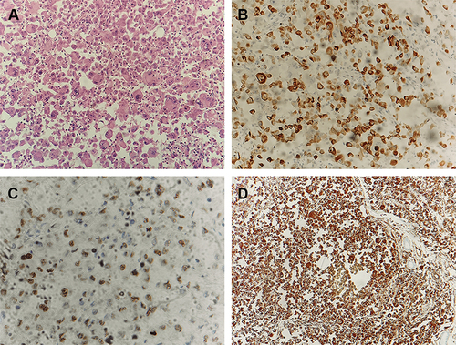 Figure 2 Skin biopsy revealed tumor cells infiltrate in the dermis with extensive necrosis. The tumor cells had abundant and light staining cytoplasm, clear nucleolus, and obvious atypia (H&E, magnification: ×200) (A). Immunohistochemical stain highlighted the tumor cells, showing CK-7 (B), TTF-1 (C) and Vimentin (D) positive (magnification: ×200).