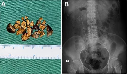 Figure 7 (A) Evacuated stone fragments during the procedure; (B) post-operative KUB photo showing no residual stone in the right kidney with correctly-positioned DJ stent.