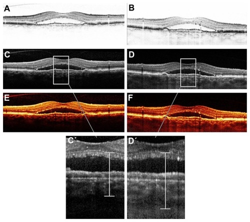 Figure 4 Vertical cross-sectional scan of the left eye through the fovea of a 79-year-old female patient displaying a central mainly serous pigment epithelial detachment. The display modalities are black/white mode in (A) (conventional) and (B) (enhanced depth imaging); white/black mode in (C) (conventional) and (D) (enhanced depth imaging); and color/heat mode in (E) (conventional) and (F) (enhanced depth imaging). Inverted scans (B, D, and F) show an increased imaging depth through the subretinal serous fluid compared to the conventional scans, shown in (C’ and D’).