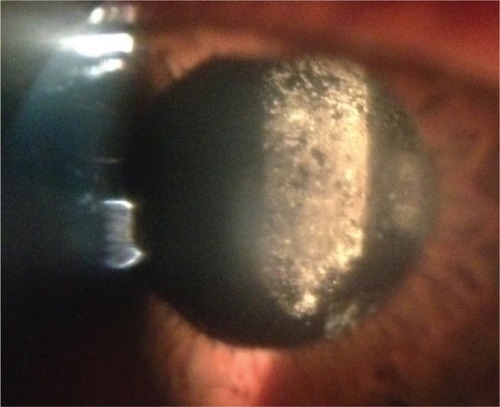 Figure 1 Smudging of posterior surface of IOL on transillumination postoperatively.