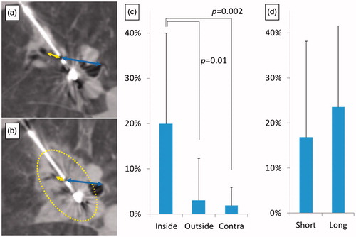 Figure 4. Distortion of lung tissue following high power microwave ablation. Distances between the centre of the ablation zone, and bronchus or large vessels both inside (yellow arrow) and outside (blue arrow) the ablation zone were measured on CT images before (a) and immediately after ablation (b). The distance between the ablation centre and these structures decreased significantly within the ablation when compared with structures outside the ablation zone, or equivalent measurements performed in untreated contralateral lung (c). The distortion ratio between short (2 min) and long duration (10 min) was not significantly different (d). Dotted lines demarcate the ablation zone from untreated lung.