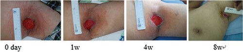 Figure 5. Wan Pengfei, male, 57 years old, suffered from skin ulceration and infection after undergoing left axillary surgery. The infection was recurrent and uncured for more than 1 month. The wound healing rate was 79% after 8 weeks of routine dressing change treatment.