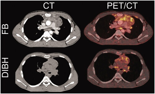 Figure 3. Notice the anatomical changes in the lymphoma in deep inspiration breath-hold (DIBH) compared to free breathing (FB). The lymphoma separates from the chest wall and extension into the chest wall or sternum and involvement of the internal mammary lymph nodes can be assessed in DIBH.