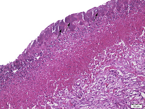 Figure 2. Granulation tissue (GT), fibro-necrotic debris, degenerated neutrophils and bacterial colonies (arrows) in surface of epicardium.