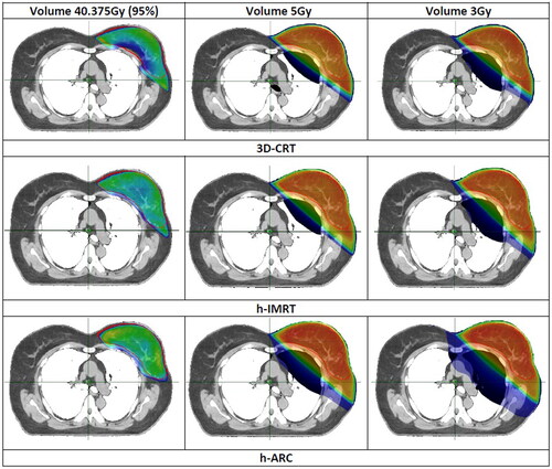 Figure 2. Comparison of isodose distributions between three-dimensional conformal radiotherapy (3D-CRT), hybrid intensity-modulated radiotherapy (h-IMRT) and hybrid volumetric-modulated arc therapy (h-ARC). The color-wash thresholds are: 3, 5, and 40.375 Gy, which is 95% of the prescribed dose.
