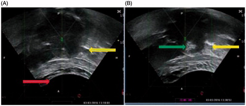 Figure 1. Real-time ultrasound monitoring images from a 42 years old patient. (A). An ultrasound image obtained before HIFU. A degassed water balloon (arrow) was used to push bowel away, the small loops of bowel (arrow) was detected outside the acoustic field. (B). A significant grey scale change was observed in the fibroid (arrow).