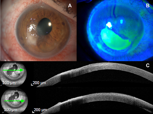Figure 1 (A) – Slit-lamp image with visualization of anterior peripheral stromal infiltrate; (B) – An extensive area that is stained with fluorescein; (C) – Corneal-OCT shows epithelial and stromal changes – the green arrows under the caption on this figure (on the left) correspond to the cornea that is expressed in all its extension and by layers in (C) (on the right).