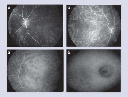 Figure 9. Acute phase Vogt–Koyanagi–Harada disease.(A) Early-phase indocyanine green angiograms shows a marked choriocapillaris filling delay and (B) choroidal vascular fuzziness due to perivascular leakage. (C) Intermediate-phase indocyanine green angiography shows numerous hypofluorescent dark dots. (D) Late-phase indocyanine green angiography shows optic disc hyperfluorescence.
