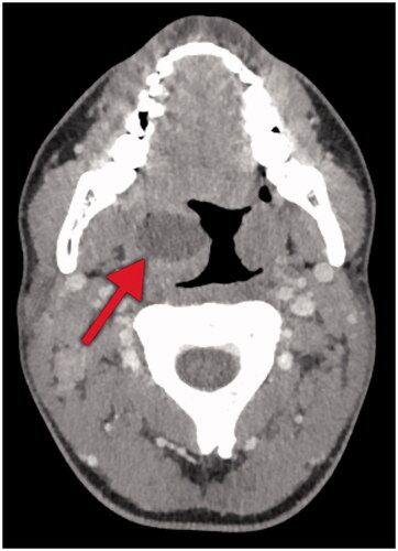 Figure 2. Computed tomography in the axial plane of the patient in case 1. Note the intratonsillar lesion (arrow) with low attenuation on the right side, measuring 26x19x20 millimeters, indicating an abscess.