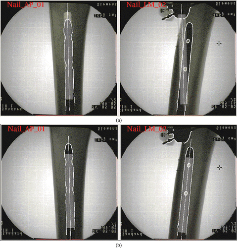 Figure 4. Example of the initialization (a) and final result (b) of automatic nail localization. The geometric model of the DP-IMN and its axis are superimposed on the images together with the detected “raw” edge pixels.