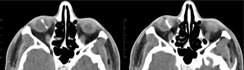 Figure 1 Axial computed tomography scan of the orbits shows metallic intraocular foreign body of the right eye measuring 14 mm in length.