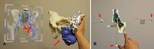 Figure 3 (A) shows the 3D-printed physical model (red arrow) and holographic virtual model in a patient with a pelvic giant cell tumor of bone. When viewing holograms, surgeons use hand gestures or voice commands to call up information instead of touching a keyboard or mouse to keep their hands free for the clinical tasks. Although the 3D-printed physical model gives tactile feedback, the surgeon needs to hold it by hand and without image feedback. Users can also analyze different sections of holographic bone models by enlarging, moving, and rotating the holographic contents by hand gestures. (B) shows the coronal view of the holographic CT bone model in a patient with a giant cell tumor involving the left femoral head and neck. The surgeon can view the different slices of the virtual model’s coronal, sagittal, and axial views by controlling the virtual buttons (red arrows). Video S1.