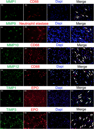 Figure 4 Immunofluorescent staining of MMP1, MMP10 and MMP12 (green) with CD68 (red); MMP9 (green) with neutrophil elastase (red); TIMP1 and TIMP3 (green) with EPO (red) in NP. DAPI (blue) stained in cell nucleus. White Arrows indicated the double staining cells of MMPs and inflammatory cells that expressed the corresponding markers. Original magnification ×400 (Scale bar = 20μm).