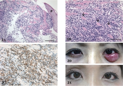 Figure 2 A) Light micrograph of hematoxylin and eosin stained eyelid biopsy specimen. Lymphoma cells were infiltrated into the subcutaneous tissue. P, palpebral skin; Bar = 200 μm. B) High magnification of the lymphoma cells infiltrated in the orbicular muscles (arrows). Bar = 100 μm. C) Light micrograph of eyelid biopsy specimen immunostained with CD3 antibody. CD3 positive lymphoma cells were distributed in the subcutaneous tissue. Bar = 100 μm. Photographs of eyelids before D) and after irradiation E) The eyelid tumor was dramatically improved after irradiation.
