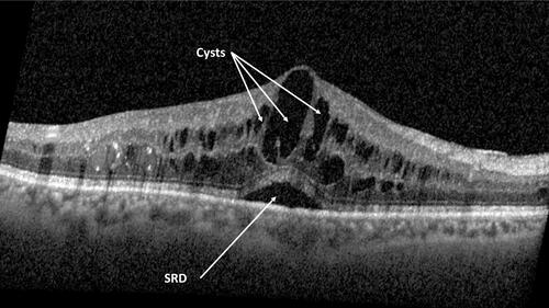 Figure 1 Spectral domain optical coherence tomography image of an eye with cystoid macular edema (CME) and serous retinal detachment (SRD).