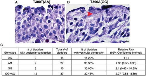 Figure 9. The ATG16L1T300A variant leads to superficial cell architectural alterations in human bladders. (a and b) Hematoxylin and eosin staining of human bladder tissue biopsies from participants carrying ATG16L1 rs2241880 AA (a) and GG (b) alleles. Red arrowhead, vesicles. (c) Percentage of human bladders of the indicated genotype that showed a vesicular congestion phenotype.