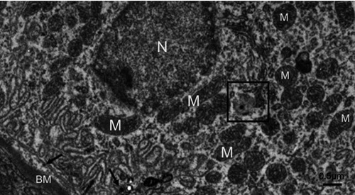 Figure 13 A distal tubule lining epithelial cell in the NiNP-treated group. Few numbers of mitochondria are seen. The box shows a vacuole containing an electron dense particle and whole vacuole is seen surrounded by an adjacent mitochondrion. Number of electron dense particles, probably NiNPs, near the basement membrane are seen (arrows).Abbreviations: NiNPs, nickel nanoparticles; M, mitochondria; N, nucleus; BM, basement membrane.