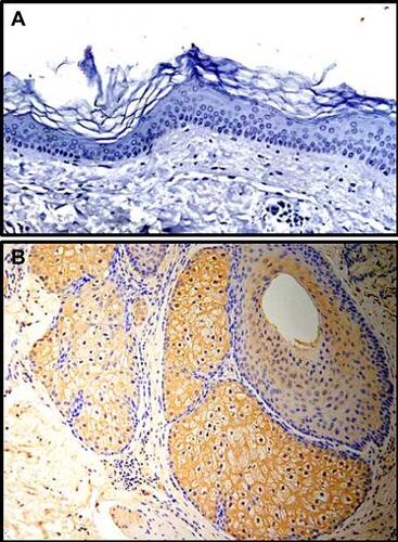 Figure 1 (A) Immunohistochemistry (IHC) showing K17 not being expressed in normal healthy skin (NHS); (B) but expressed in hair follicles and sebaceous glands (all magnifications 200×).