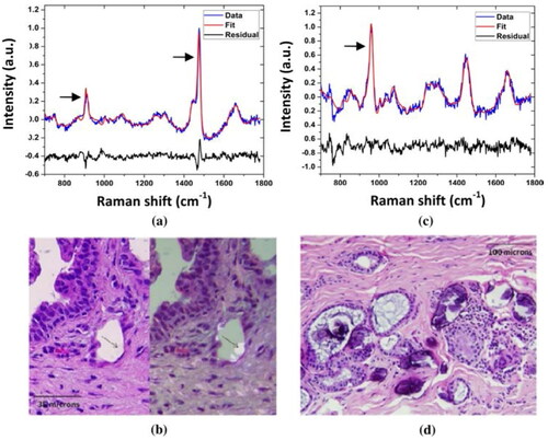 Figure 7. Typical Raman spectra and histopathology of breast lesions (fibrocystic change) with type I and II microcalcifications. The Raman spectrum of the breast lesion with type I microcalcifications in (a) shows prominent bands at 912 cm−1 and 1477 cm−1 (arrows) characteristic of calcium oxalate; the calcium oxalate crystals comprising the type I microcalcifications (b) do not bind H&E (left panel) and appear as colorless crystals (arrows) that are birefringent when viewed under polarized light (right panel). In contrast, the Raman spectrum of the breast lesion with type II microcalcifications in (c) shows a prominent band at 960 cm−1 (arrow) characteristic of calcium hydroxyapatite; the calcium hydroxyapatite rich type II microcalcifications appear as basophilic concretions on the H&E stain (d) and are non-birefringent. Reprinted with permission from [Citation107]. Copyright [2011] Optica publishing group.