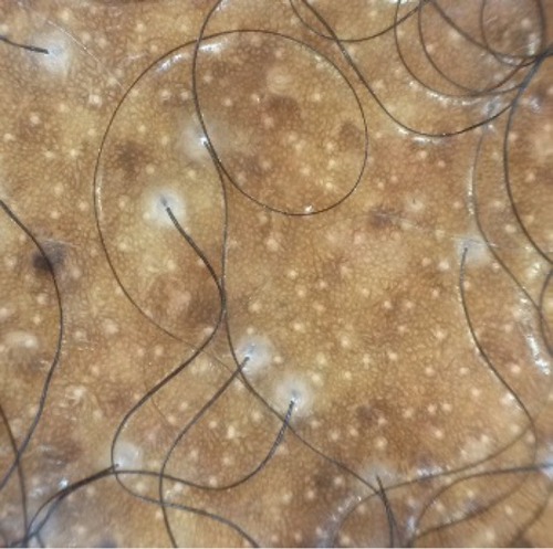 Figure 3 Dermoscopic findings of CCCA include peripilar gray/white halo, which is a suitable site for a scalp biopsy, disrupted pigmented network, and loss of follicular openings.