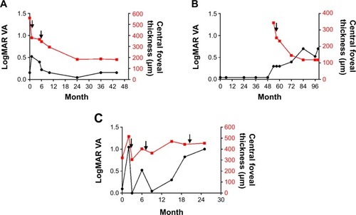 Figure 1 Response of choroidal osteoma to intravitreal injections of bevacizumab.