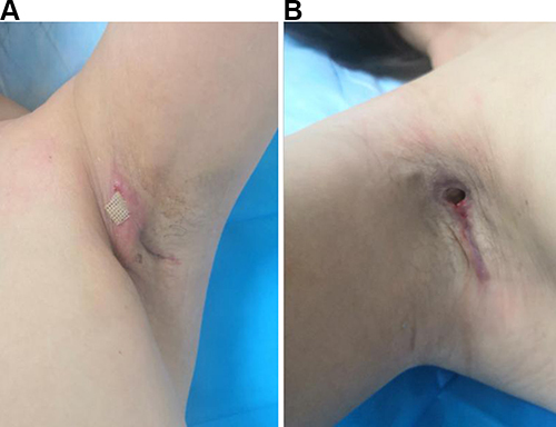 Figure 1 Bilateral axillary wound showed dehiscence at admission. (A) Despite the removal of bilateral breast implants and the use of red and blue light anti-inflammatory treatment, there was still evidence of bilateral axillary wound dehiscence with purulent yellow-green discharge. (B) A subcutaneous cavity was visible in the right armpit.
