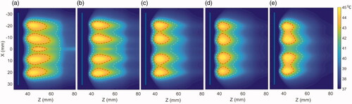 Figure 5. Effect of the operating frequency on hyperthermia temperature distribution in the generalized tissue model for (a) 1 MHz, (b) 1.5 MHz, (c) 2.45 MHz, (d) 3.4 MHz, and (e) 4.7 MHz, with applicator geometry I (6 cm aperture, two 1 cm OD × 1 cm long transducers). The red and cyan contours are 43 and 40 °C, respectively. Nominal values of attenuation and perfusion level were used. The cooling flow water temperature was 20 °C.