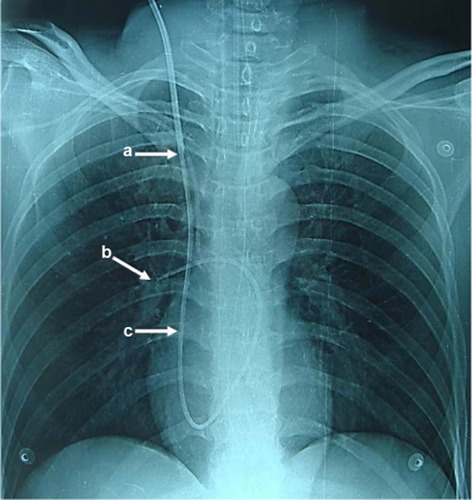 Figure 1 The different cold saline injection sites in the present study.