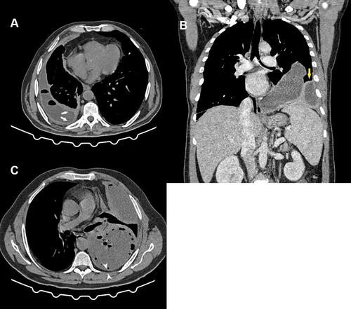 Figure 2 Thoracic computed tomography demonstrating features of pleural infection. (A) Axial cut in mediastinal window showing a right-side pleural effusion with multiple air foci and “split pleura” (white arrows). (B) After intravenous contrast injection (coronal reconstruction in mediastinal window), showing left-side multiloculated empyema with enhancing pleural thickening (yellow arrow). (C) Axial cut in mediastinal window showing a left-side multiloculated pleural empyema with multiple air foci and posterior parietal pleural thickening and extrapleural fat hypertrophy (arrowheads).