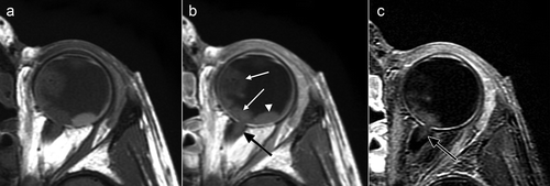 Figure 1. Precontrast (a), postcontrast (b), and subtraction (c). T1-weighted MR images of the left eye showing contrast enhancement of the tumor (white arrows in b) and distal optic nerve (black arrow in b). Enhancement of the optic nerve (black arrow in b and c) reached 3 mm from the lamina cribrosa into the optic nerve and reached the outer edges (width of the postlaminar enhancement was about 3.5 mm). Temporal from the tumor the retina has detached and shows T1-hyperintense subretinal fluid (white arrowhead in b), but no enhancement (no signal on the subtraction image, c).