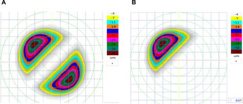 Figure 4 The schematic description of LAK-SCAP. (A) shows examples of axial, symmetric images of two-partial ablation patterns. (B) shows examples of laser ablation patterns for LAK-SCAP; specifically, it shows one partial ablation for existing cylindrical ablation patterns, as seen in (A). These patterns can be achieved by blocking laser corneal ablations at the thinner sections of the cornea.