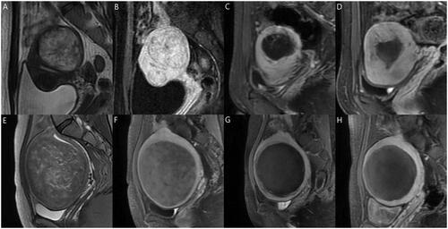 Figure 6. (A–D) A 29-year-old woman with a single uterine fibroid in the testing set. T2WI type: IV; FIGO type: 3; CE-MRI showed rich blood supply. The patient returned for MRI review 100 days after postoperative MRI evaluation. Maximum thickness of residual fibroids: 0.85 cm. Basal distribution of residual fibroids: two quadrants. Postoperative NPV: 37.3 cm3; postoperative RFV: 27.0 cm3; NPVR: 58.01%. NPV reduction value: 26.7 cm3. RFV increased by 19.63%. Predictive result of the NPV reduction value: 25.7 cm3; predictive result of residual fibroids: regrowth. (E–H) A 32-year-old woman with a single uterine fibroid in the testing set. T2WI type: III; FIGO type: 4; CE-MRI showed a lack of blood supply. The patient returned for MRI review 105 days after postoperative MRI evaluation. Maximum thickness of residual fibroids: 0.65 cm. The basal distribution of residual fibroids: two quadrants. Postoperative NPV: 332.7 cm3; postoperative RFV: 26.1 cm3; NPVR: 92.73%. NPV reduction value: 135.9 cm3. RFV decreased by 18.77%. Predictive result of NPV reduction was 103.8 cm3; predictive result of residual fibroid: non-regrowth. CE-MRI: contrast-enhanced magnetic resonance imaging; FIGO: International Federation of Gynecology and Obstetrics; T2WI: T2-weighted imaging; NPV: non-perfused volume; RFV: residual fibroid volume.