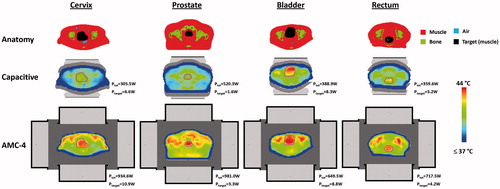 Figure 12. Transversal slices of the simulated temperature distribution for small fatless cervix, prostate, bladder and rectum cancer patients heated with capacitive electrodes (25 + 25 cm) using overlay boluses or the radiative AMC-4 system. The maximum temperature in all distributions is 44 °C. The total power absorbed in the patient (Ptot) and in the target region (Ptarget) is indicated for each distribution. Cross-sections are at the centre of the target region in axial direction. The contour in the temperature distributions indicates the target region.