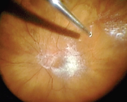 Figure 3 Enhanced visibility of epiretinal membrane with triamcinolone.