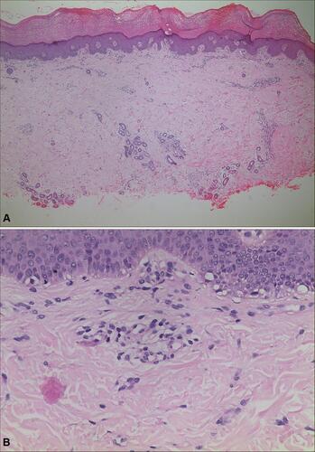 Figure 3 Histopathological findings show hyperkeratosis, thickening of the stratum spinosum (A) (H&E, 40X) and mild perivascular lymphocytic infiltration in the papillary layer of the dermis (B) (H&E, 200X).