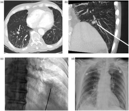 Figure 3. An 81-year-old man underwent RF ablation of pulmonary metastasis from colorectal carcinoma in the anterior basal segment of the right lower lobe. (a) Chest CT obtained before RFA shows the tumor (arrow), which demonstrates the intimate relation of central pulmonary lesions with the blood vessels, thereby increasing the risk of pulmonary hemorrhage. (b) CBCT image during insertion of RF electrode. Notice traversing the intervening pulmonary vessels by the needle electrode. (c) C-arm fluoroscopy image showed the extent of intra-parenchymal hemorrhage after the insertion of the electrode. Immediate termination of the ablation session was decided because of excessive hemoptysis and deterioration of the clinical condition of the patient. The patient was treated in the intensive care unit. (d) After 3 h, progressive increase in pulmonary hemorrhage was observed in chest plain radiography.