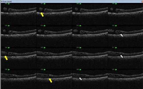 Figure 4 Serial OCT axial scans showing subretinal fluid (yellow arrows) in the area of retinal holes and neurosensory retina cystic changes (white arrows).